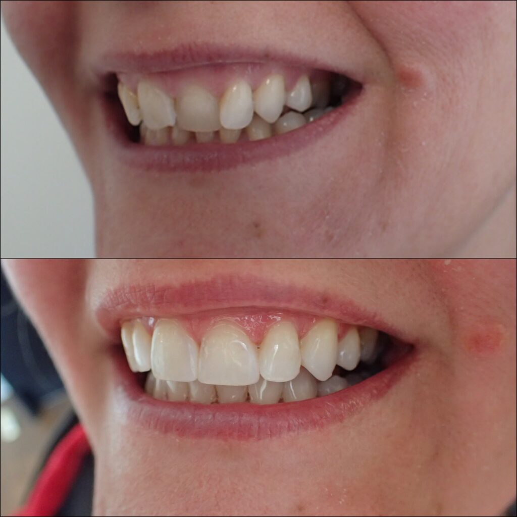 Teeth Straightening Wellington