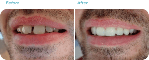 Teeth Straightening Wellington