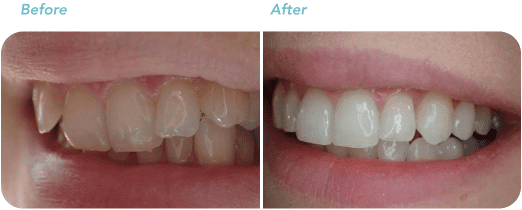 Teeth Straightening Wellington