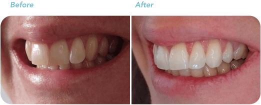 Teeth Straightening Wellington