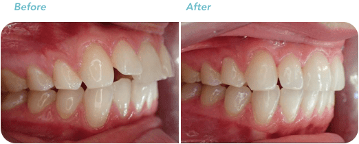 Teeth Straightening Wellington